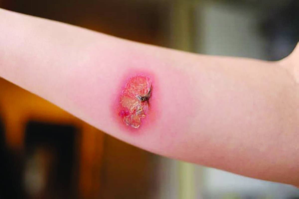 A close-up of a nanotechnology-based wound treatment platform featuring silver nanoparticles applied to a wound surface.