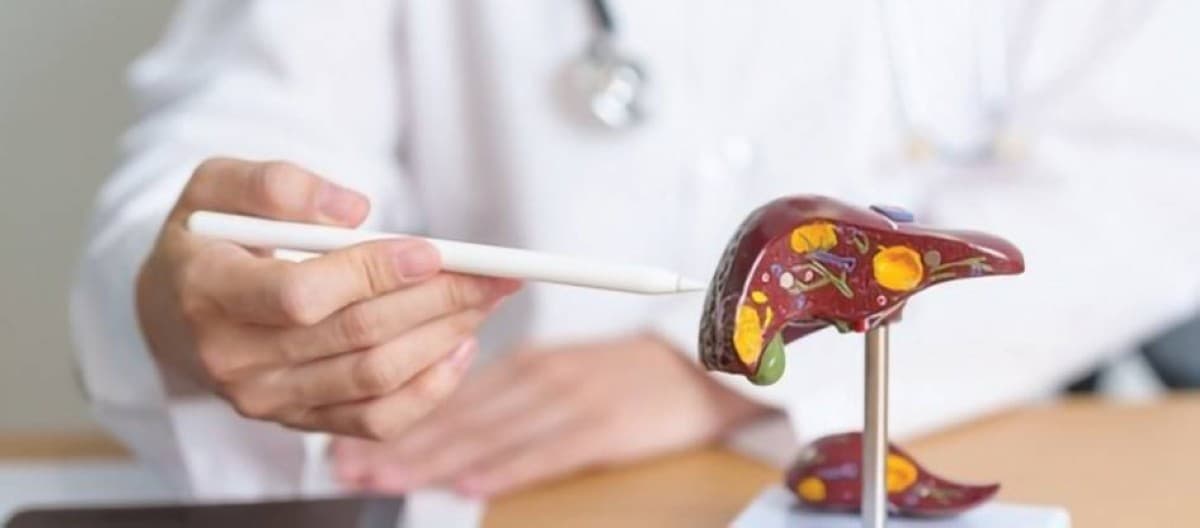 A medical illustration depicting colorectal cancer and its connection to fatty liver disease.
