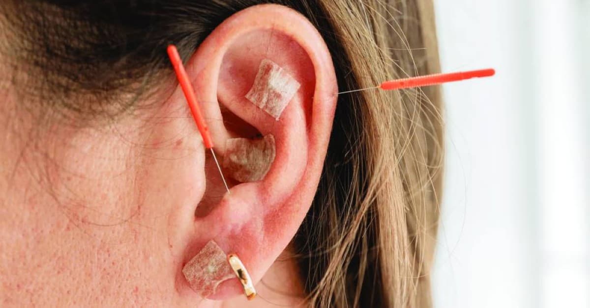 A close-up of an ear receiving acupuncture needle treatment, illustrating a clinical study on ear acupuncture as a therapy for chronic migraines.