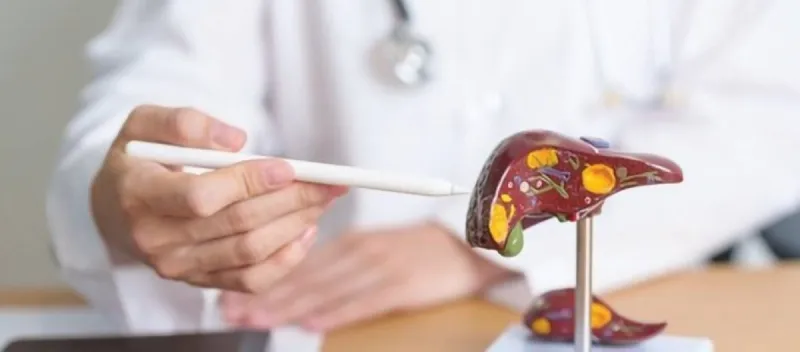 A medical illustration depicting colorectal cancer and its connection to fatty liver disease.